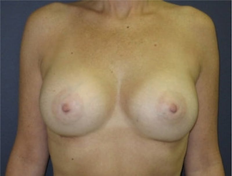 Breast Augmentation Before & After Gallery - Patient 989504 - Image 2