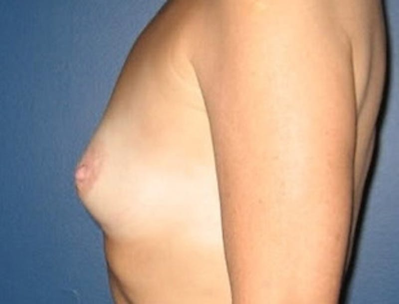 Breast Augmentation Before & After Gallery - Patient 989504 - Image 3
