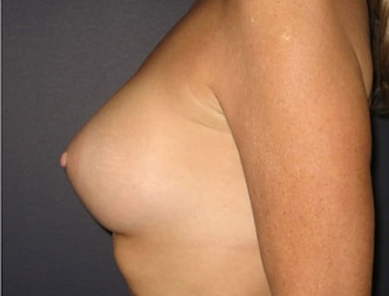 Breast Augmentation Before & After Gallery - Patient 989504 - Image 4