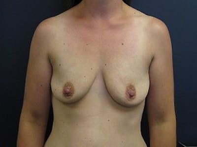 Breast Augmentation Before & After Gallery - Patient 285549 - Image 1
