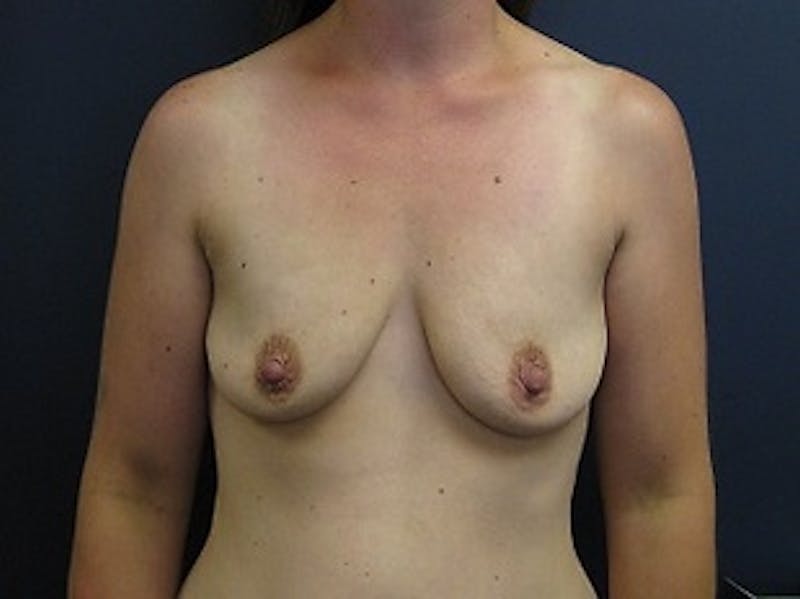 Breast Augmentation Before & After Gallery - Patient 285549 - Image 1