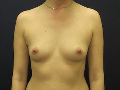 Breast Augmentation Before & After Gallery - Patient 307627 - Image 1