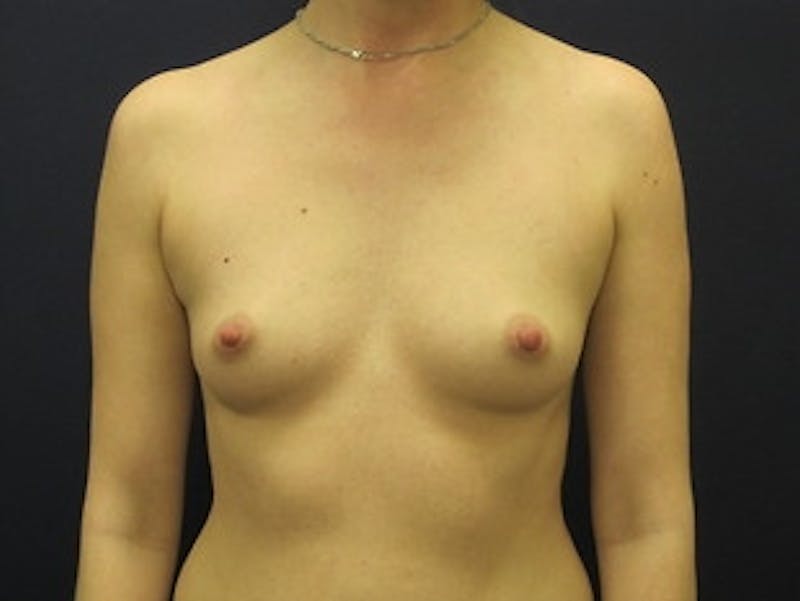 Breast Augmentation Before & After Gallery - Patient 307627 - Image 1