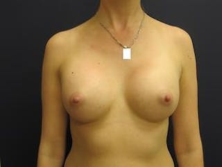 Breast Augmentation Before & After Gallery - Patient 307627 - Image 2