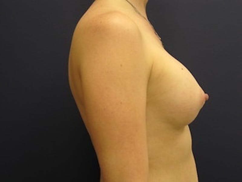 Breast Augmentation Before & After Gallery - Patient 307627 - Image 4