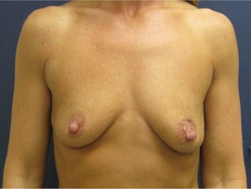 Breast Augmentation Before & After Gallery - Patient 227056 - Image 1