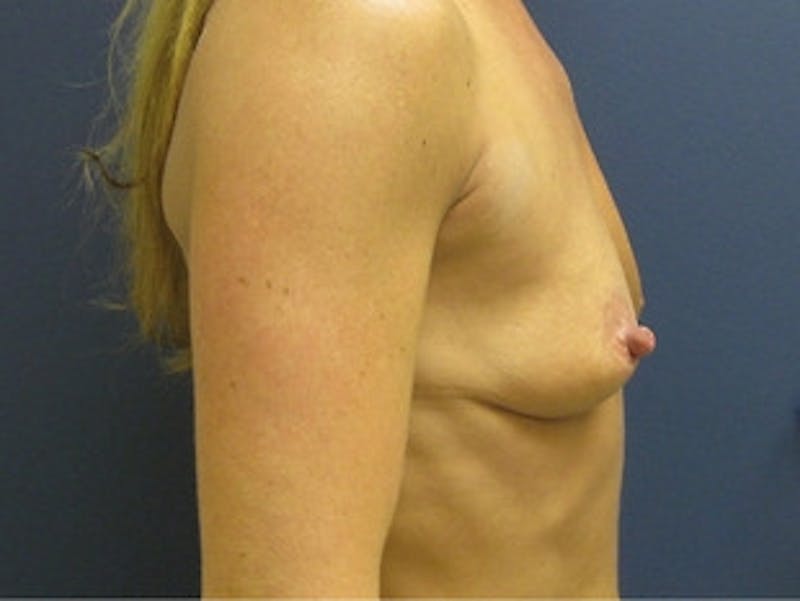 Breast Augmentation Before & After Gallery - Patient 227056 - Image 3