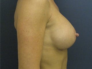 Breast Augmentation Before & After Gallery - Patient 227056 - Image 4