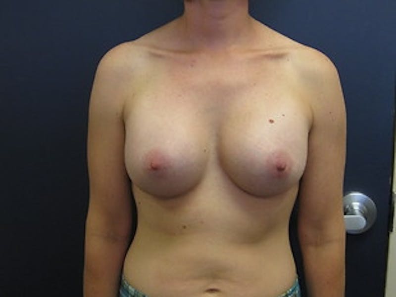 Breast Augmentation Before & After Gallery - Patient 173945 - Image 2
