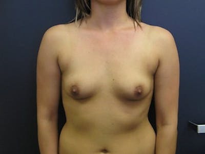 Breast Augmentation Before & After Gallery - Patient 349054 - Image 1