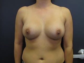 Breast Augmentation Before & After Gallery - Patient 349054 - Image 2