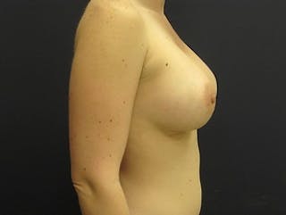 Breast Augmentation Before & After Gallery - Patient 183075 - Image 4