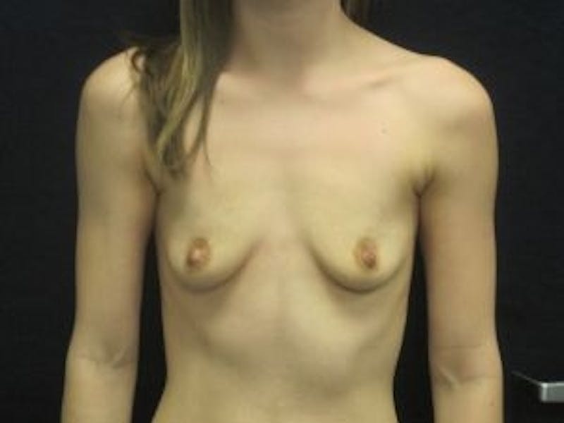 Breast Augmentation Before & After Gallery - Patient 354058 - Image 1