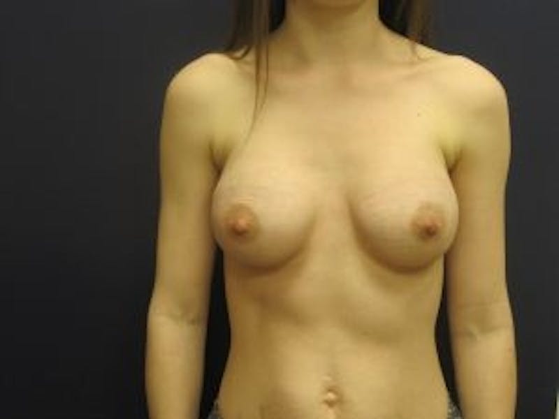 Breast Augmentation Before & After Gallery - Patient 354058 - Image 2