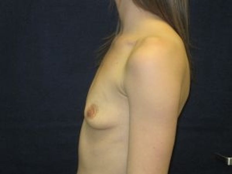 Breast Augmentation Before & After Gallery - Patient 354058 - Image 3