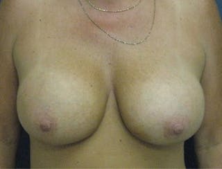 Breast Augmentation Before & After Gallery - Patient 710789 - Image 2