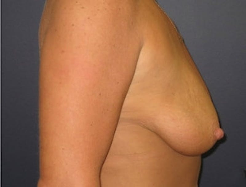 Breast Augmentation Before & After Gallery - Patient 710789 - Image 3