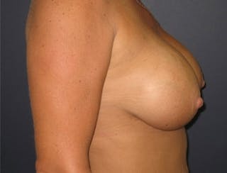 Breast Augmentation Before & After Gallery - Patient 710789 - Image 4