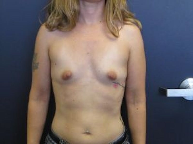 Breast Augmentation Before & After Gallery - Patient 333546 - Image 1
