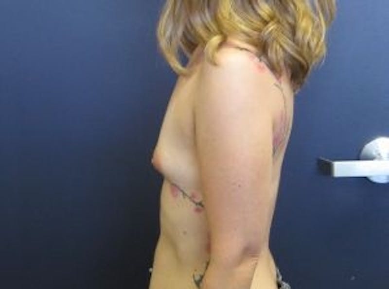 Breast Augmentation Before & After Gallery - Patient 333546 - Image 3