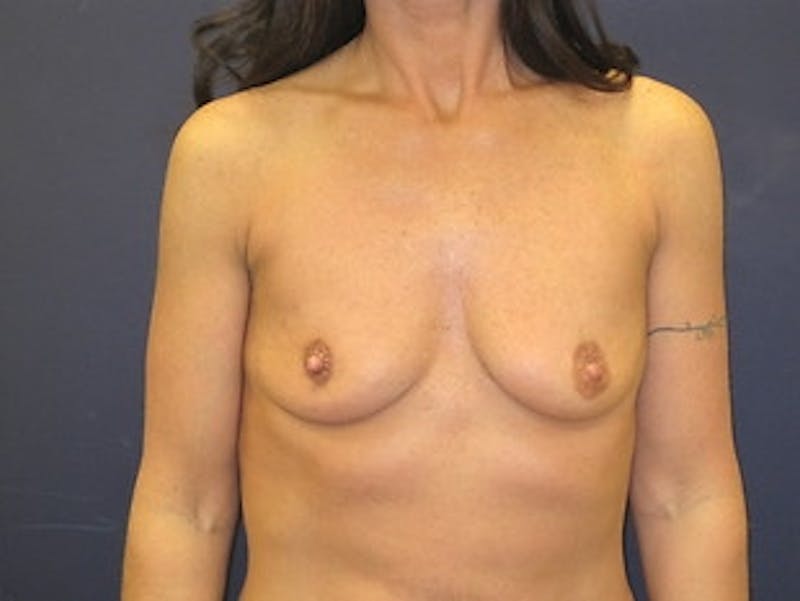 Breast Augmentation Before & After Gallery - Patient 304977 - Image 1