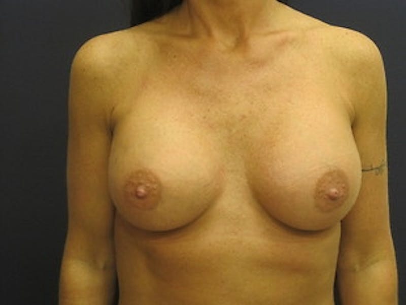 Breast Augmentation Before & After Gallery - Patient 304977 - Image 2