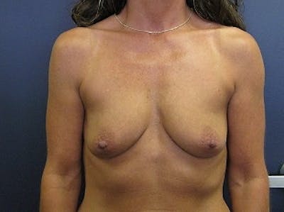 Breast Augmentation Before & After Gallery - Patient 102159 - Image 1