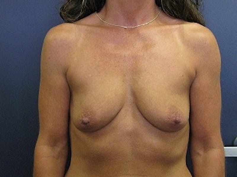 Breast Augmentation Before & After Gallery - Patient 102159 - Image 1
