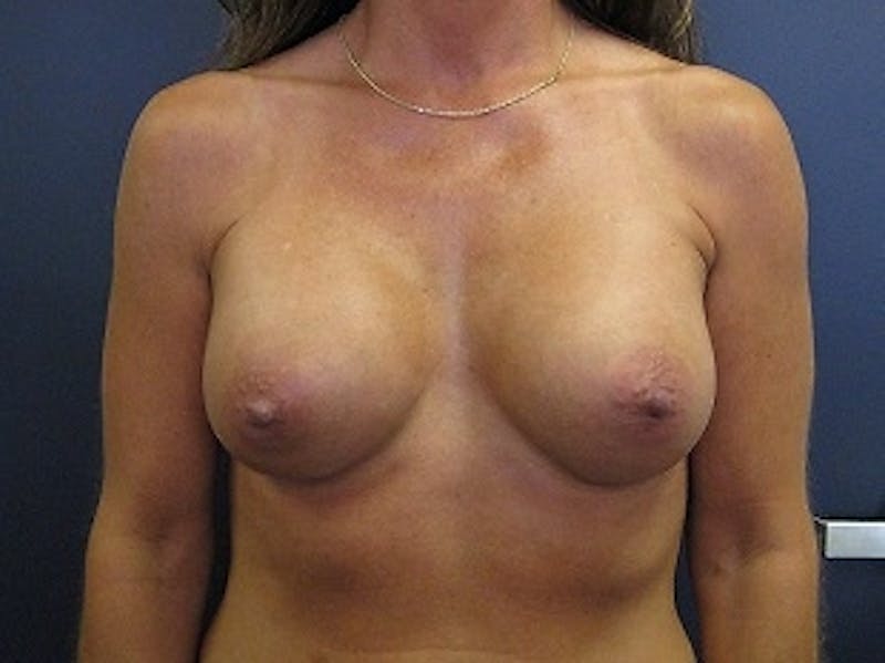 Breast Augmentation Before & After Gallery - Patient 102159 - Image 2