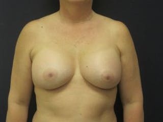 Breast Augmentation Before & After Gallery - Patient 237034 - Image 2