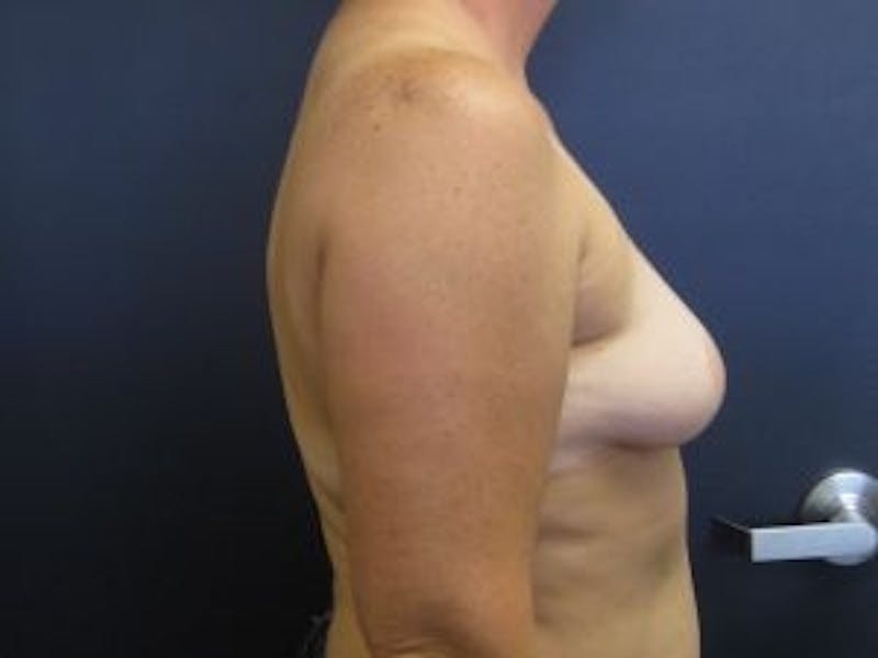 Breast Augmentation Before & After Gallery - Patient 237034 - Image 3