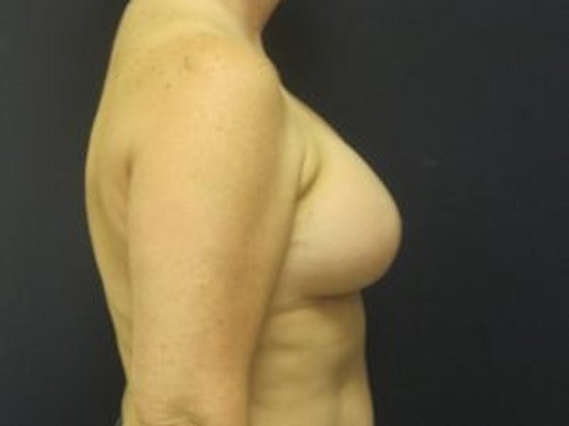 Breast Augmentation Before & After Gallery - Patient 237034 - Image 4