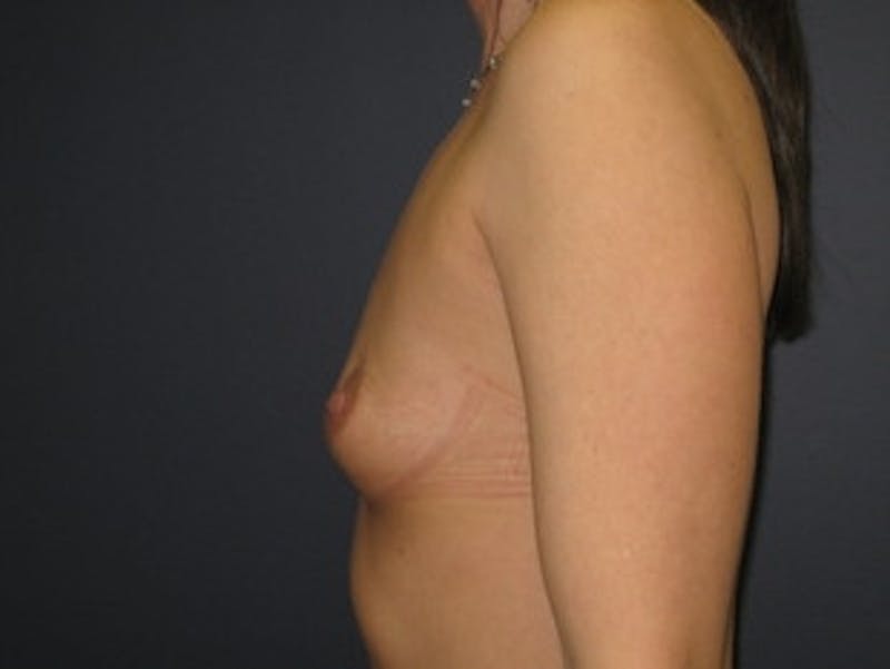 Breast Augmentation Before & After Gallery - Patient 386445 - Image 3