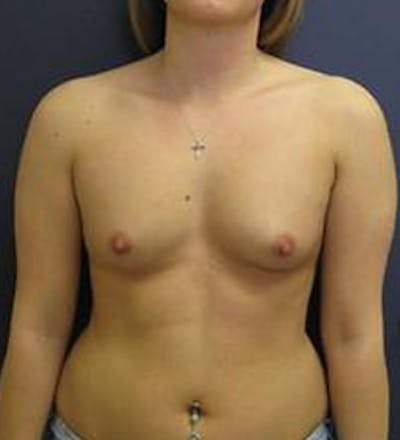 Breast Augmentation Before & After Gallery - Patient 150886 - Image 1