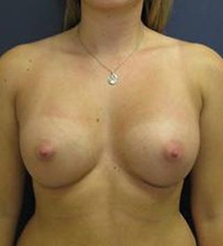 Breast Augmentation Before & After Gallery - Patient 150886 - Image 2