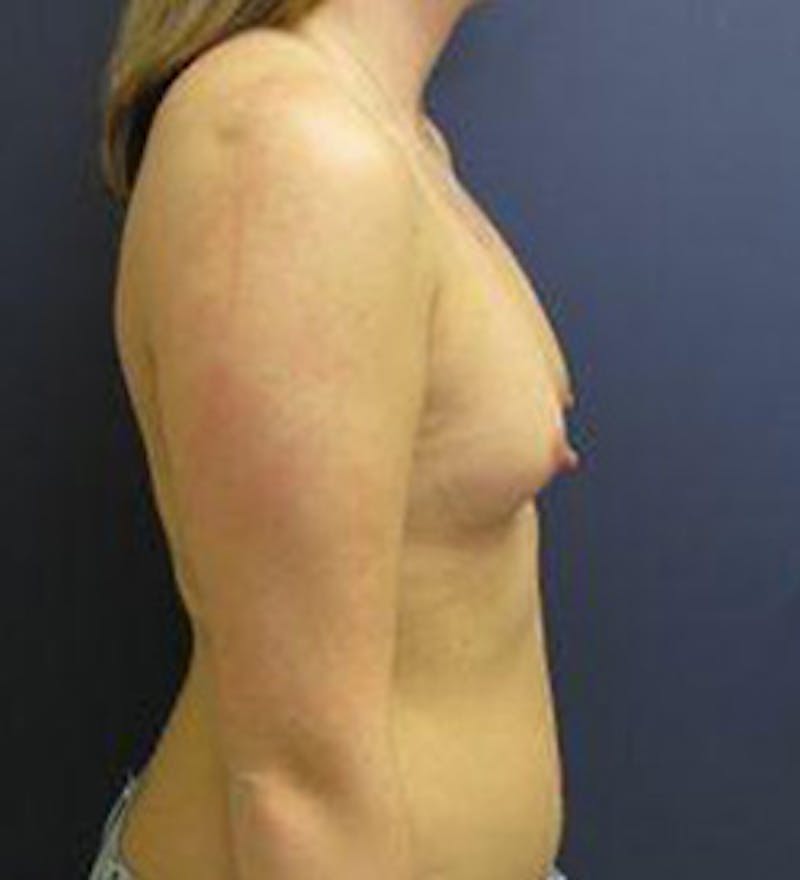 Breast Augmentation Before & After Gallery - Patient 150886 - Image 3