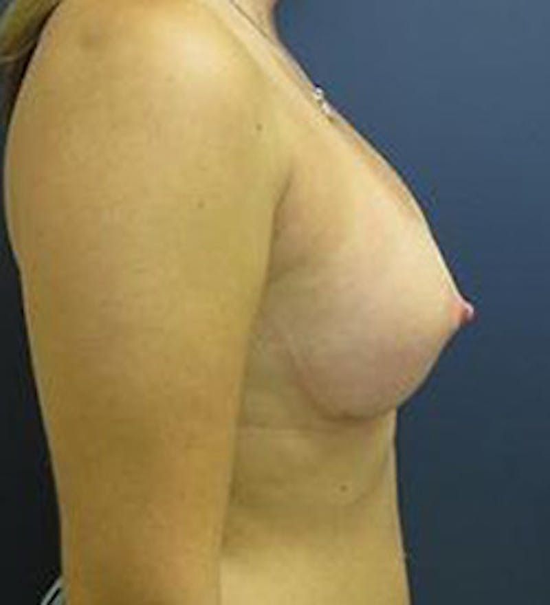 Breast Augmentation Before & After Gallery - Patient 150886 - Image 4