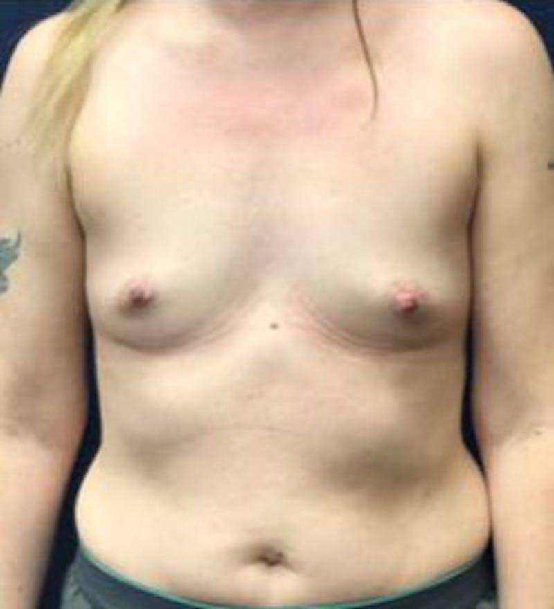 Breast Augmentation Before & After Gallery - Patient 698951 - Image 1