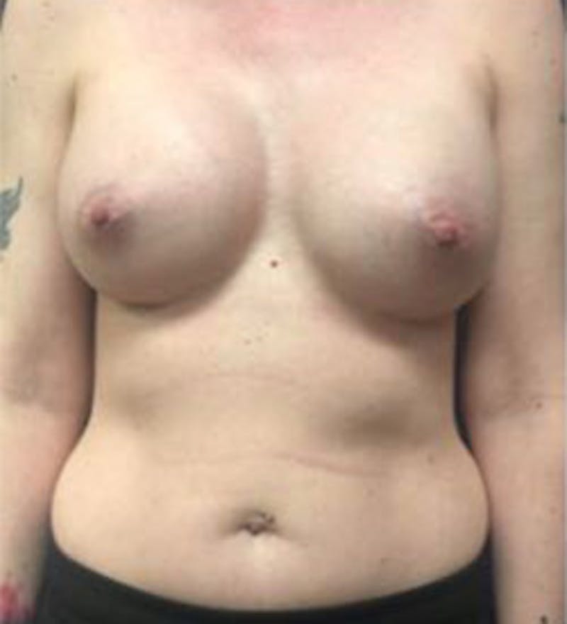 Breast Augmentation Before & After Gallery - Patient 698951 - Image 2
