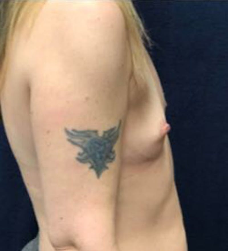 Breast Augmentation Before & After Gallery - Patient 698951 - Image 3