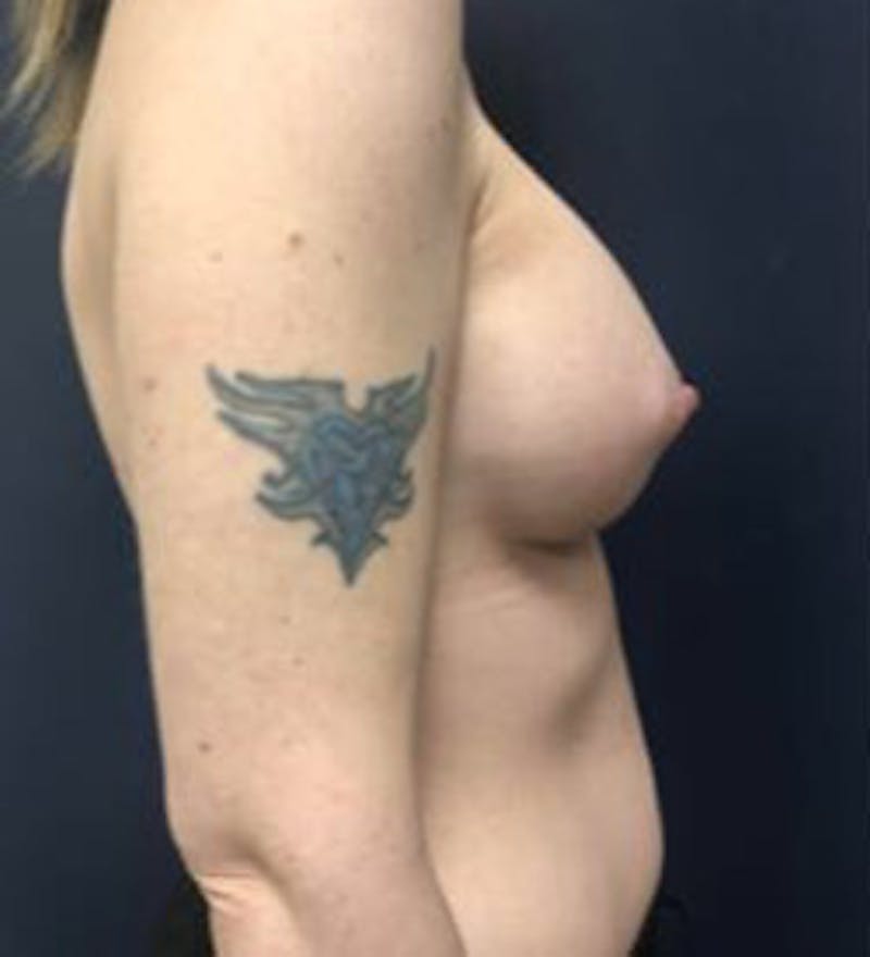 Breast Augmentation Before & After Gallery - Patient 698951 - Image 4