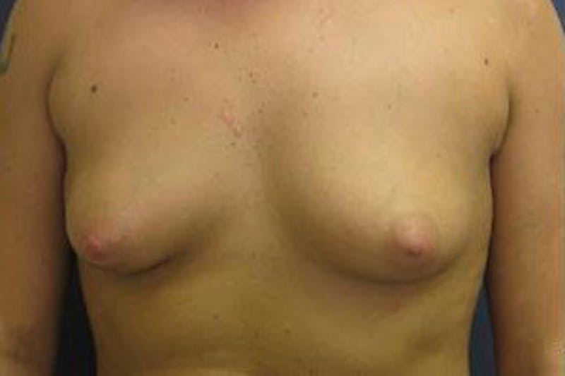 Breast Augmentation Before & After Gallery - Patient 579668 - Image 1