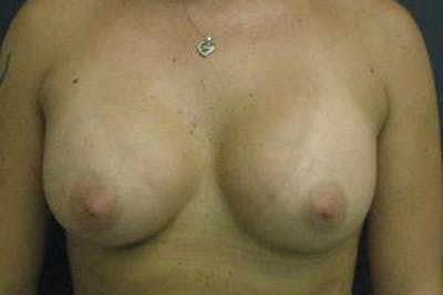 Breast Augmentation Before & After Gallery - Patient 579668 - Image 2