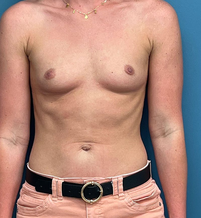 Breast Augmentation Before & After Gallery - Patient 116630 - Image 1