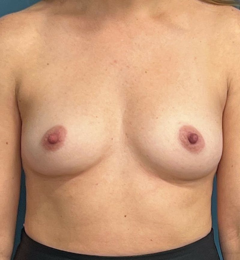Breast Augmentation Before & After Gallery - Patient 291886 - Image 1