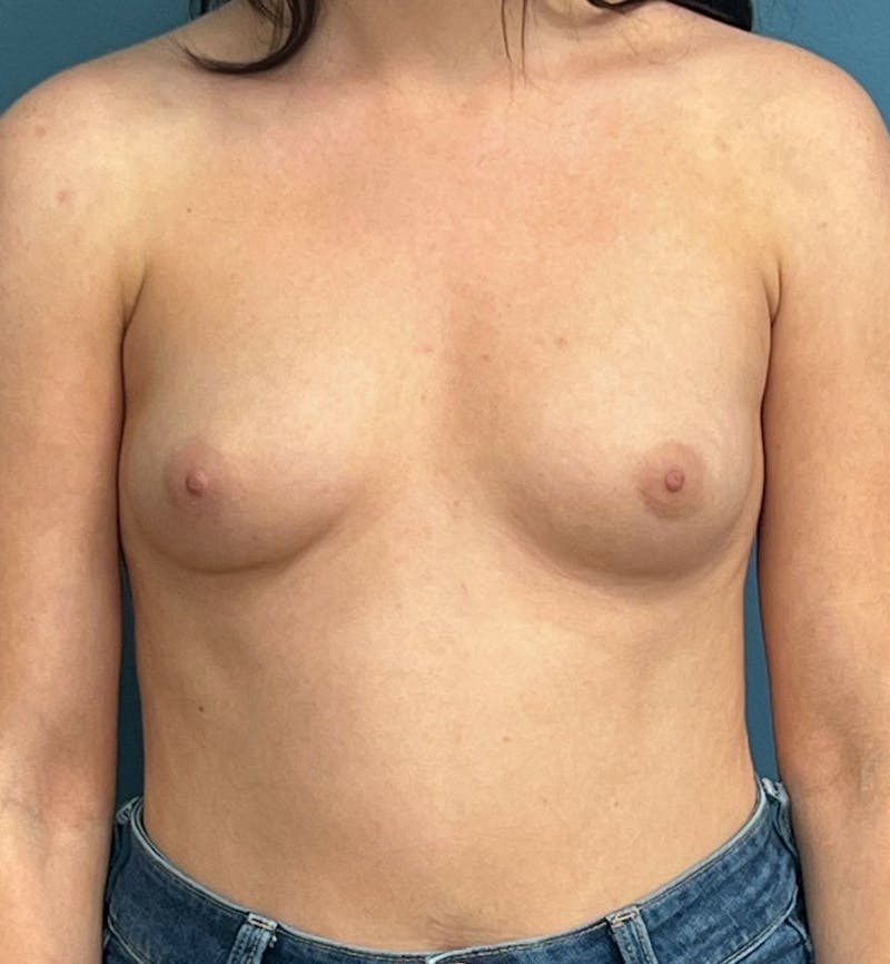 Breast Augmentation Before & After Gallery - Patient 407700 - Image 1