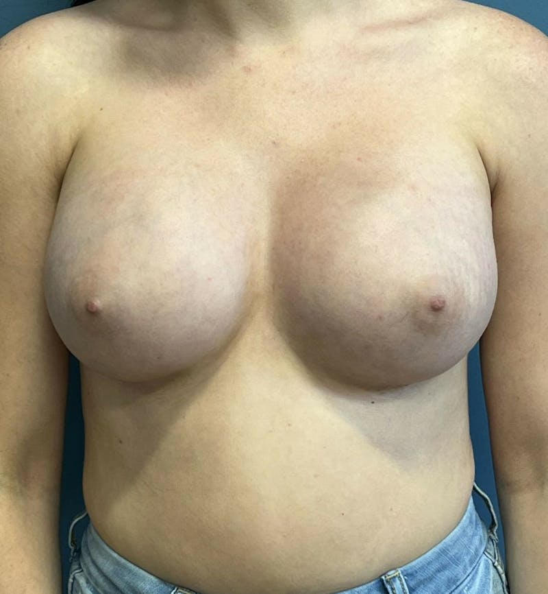 Breast Augmentation Before & After Gallery - Patient 407700 - Image 2
