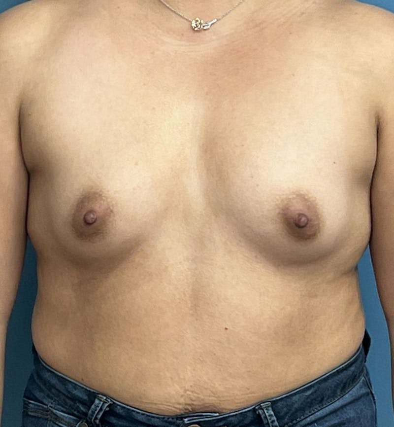 Breast Augmentation Before & After Gallery - Patient 189965 - Image 1