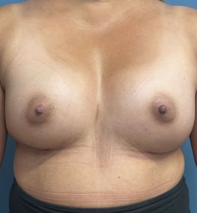 Breast Augmentation Before & After Gallery - Patient 189965 - Image 2