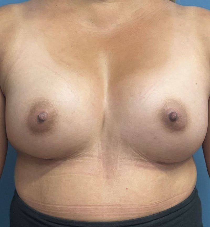 Breast Augmentation Before & After Gallery - Patient 189965 - Image 2